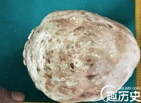 世界上最大的肾结石，长达10厘米重达2.8斤的疯狂石头