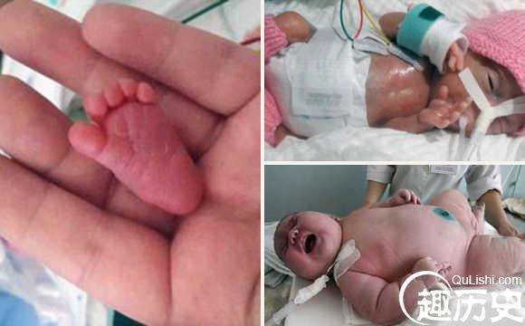 中国最小婴儿体重950克，婴儿仅巴掌大小