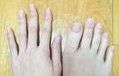 女大学生脚趾长如手指 罕见5公分灵活异常