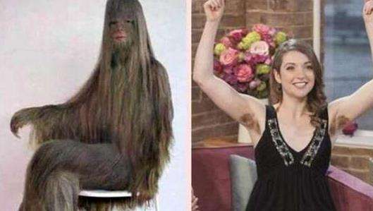 世界上体毛最多的女孩，艾米丽出生时像一个小猴子