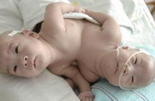 连体男婴成功分离 医生曾让做最坏打算