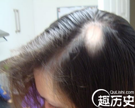 女孩8年拔光头发