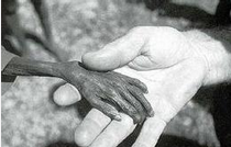日本水俣病事件:恐怖的汞中毒