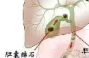 最大的人体胆结石：你能想象到多大呢？